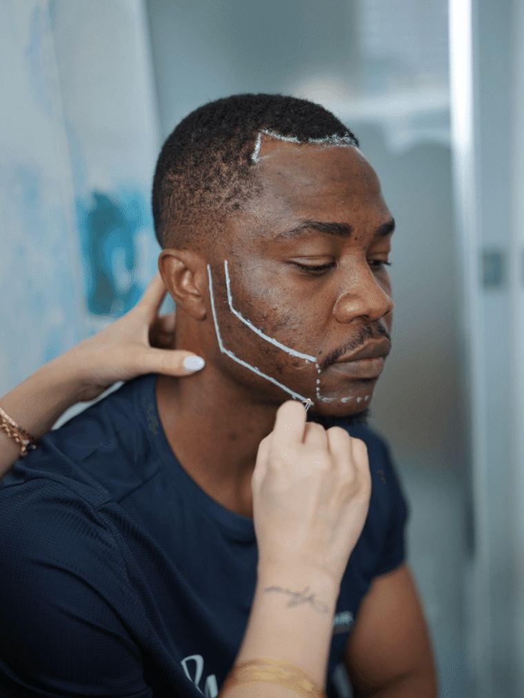 Beard line being mapped before a beard transplant